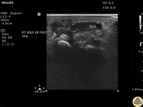 Soft Tissue - Toothpick Foreign Body