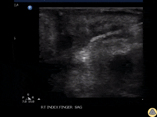 Soft Tissue - Foreign Body Removal