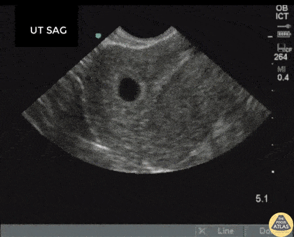 OB/Gyn - IUD Foreign Body