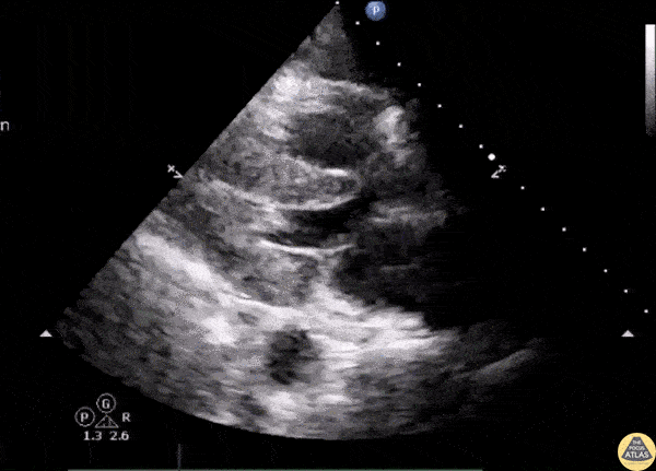 Valvulopathy - Left Ventricular Outflow Tract Obstruction