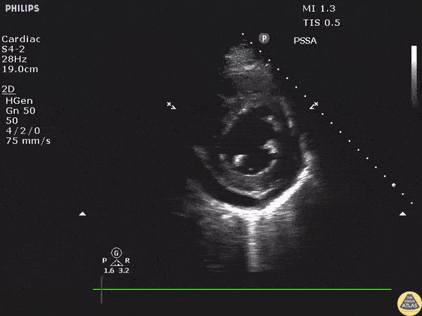 Pericardial Disease - Pericardial Effusion