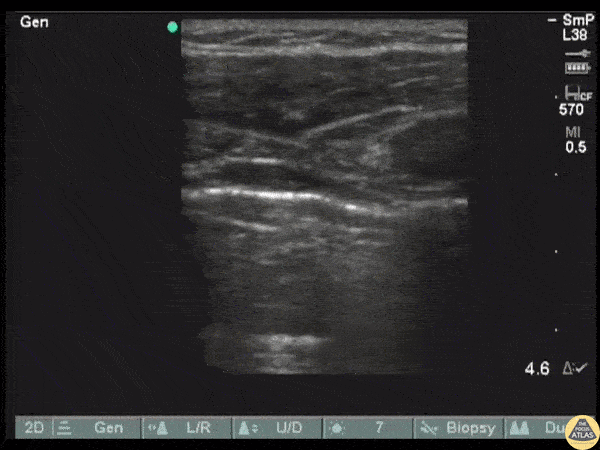 Pulmonary - Lung Re-expansion