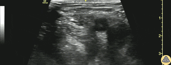 Nerve Block Gallery - Fascia Iliaca Block 2