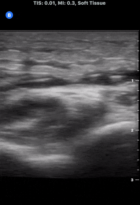 Soft Tissue - Cobblestoning in Cellulitis