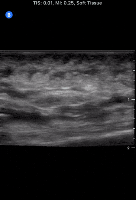 Soft Tissue - More Cobblestoning in Cellulitis