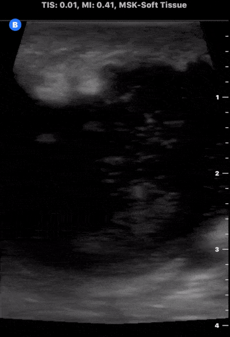 Soft Tissue - Large Soft Tissue Abscess