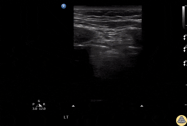 Pulmonary - Lung Pulse