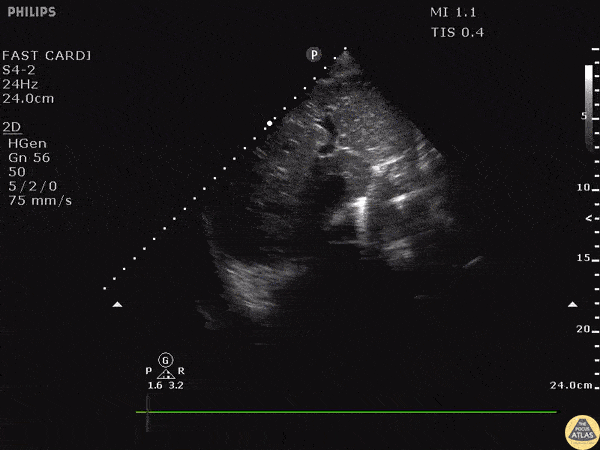 Trauma - Gunshot Wound Foreign Body