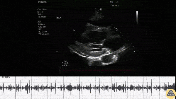 Pericardial Disease - Uremic Pericarditis
