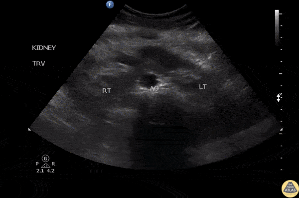 Renal/GU - Horseshoe Kidney