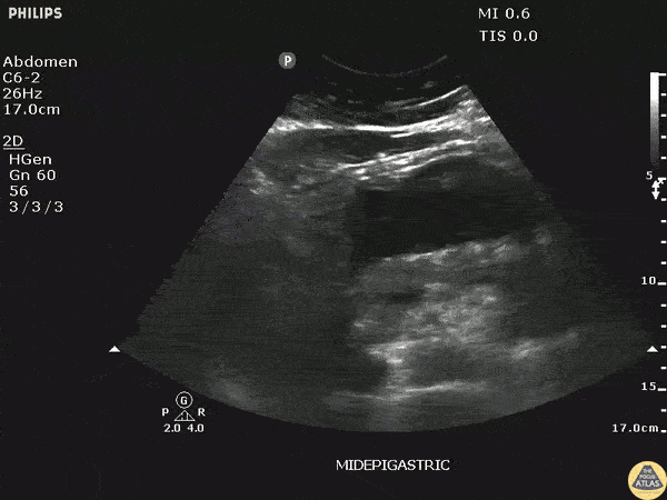 Bowel-GI - Pancreatic Pseudocyst
