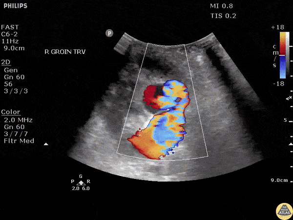 Vascular - Pseudoaneurysm