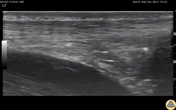 Musculoskeletal - Normal Achilles Tendon