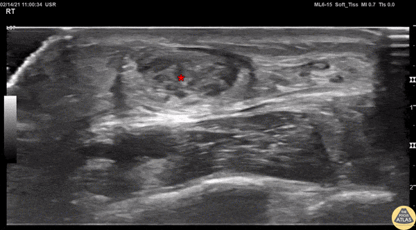 Musculoskeletal - Achilles Tendon Injury Short Ais