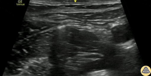 Nerve Block Gallery - Fascia Iliaca Nerve Block for Femur Fracture