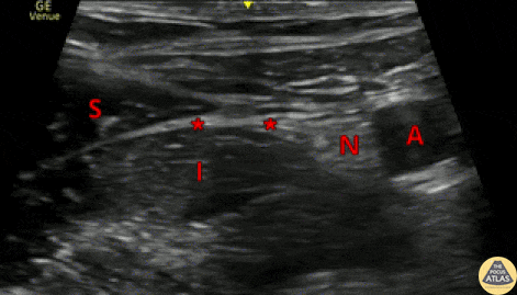 Nerve Block Gallery - Fascia Iliaca Nerve Block Anatomy