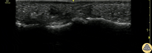 Musculoskeletal - Flexor Tendonitis