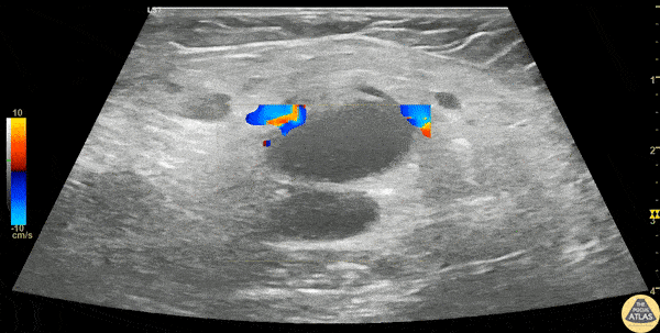 Soft Tissue - Inguinal Lymphadenitis
