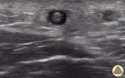 Vascular - Superficial Thrombophlebitis