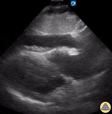 Pericardial Disease - Circumferential Pericardial Effusion with Tamponade