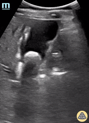 Biliary - Cholelithiasis