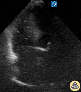 Other Cardiac Pathology - Venous Air Embolism