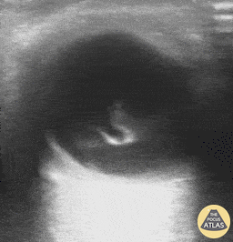 Orbital - Vitreous Hemorrhage