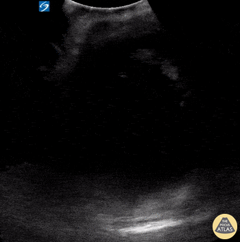 OB/Gyn - Pelvic Cystic Mass