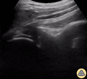 Musculoskeletal - Shoulder Relocation