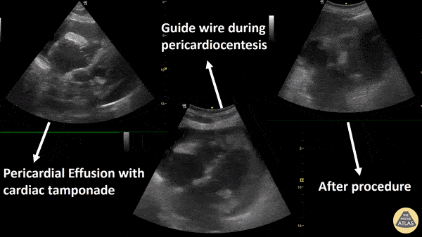 Pericardial Disease - Pre- & Post- Pericardiocentesis