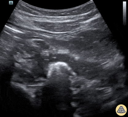 Bowel-GI - Small Bowel Obstruction