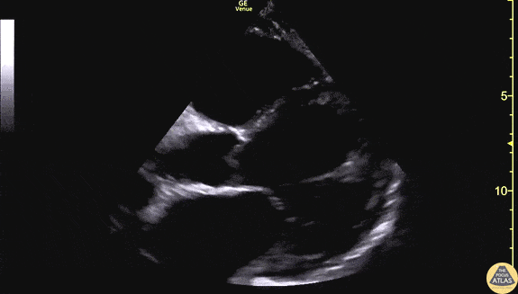 Left Ventricular Dysfunction - Reduced LV Function