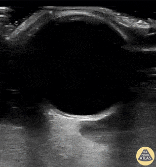 Orbital - Retrobulbar Hematoma