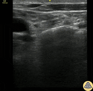 Soft Tissue - Supraclavicular Lymphadenopathy