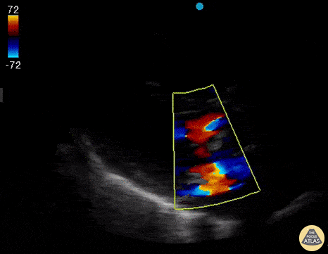 Valvulopathy - Mitral Regurgitation in Parasternal Long Axis