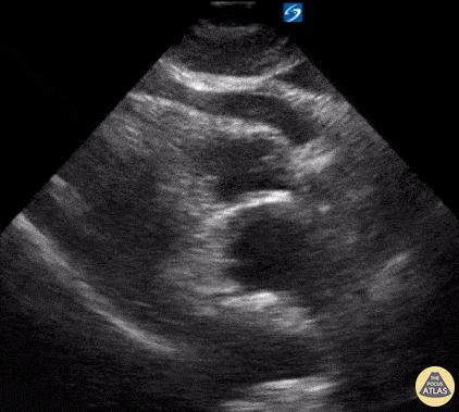 Pericardial Disease - Cardiac Tamponade secondary to Type A Aortic Dissection