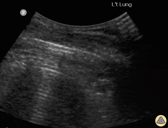 Pulmonary - Pneumothorax with Lung Point