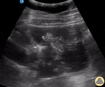 Bowel-GI - SBO with "To-and-Fro"