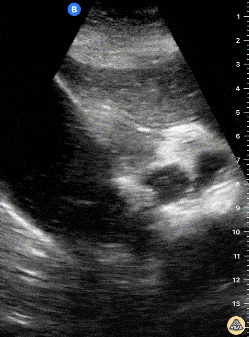 Biliary - Choledocholithiasis
