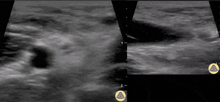 Musculoskeletal - Distal Biceps Tendon Rupture