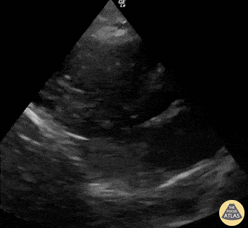 Other Cardiac Pathology - POCUS during Resuscitation