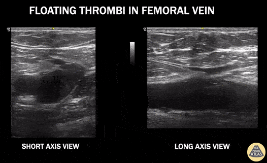 Vascular - Floating Venous  Thrombus