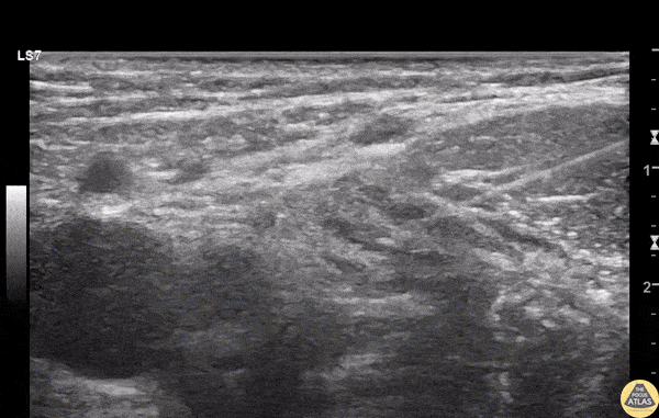 Nerve Block Gallery - Pediatric Fascia Iliaca Nerve Block