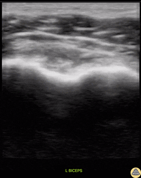 Musculoskeletal - Subscapularis Tendon Tear