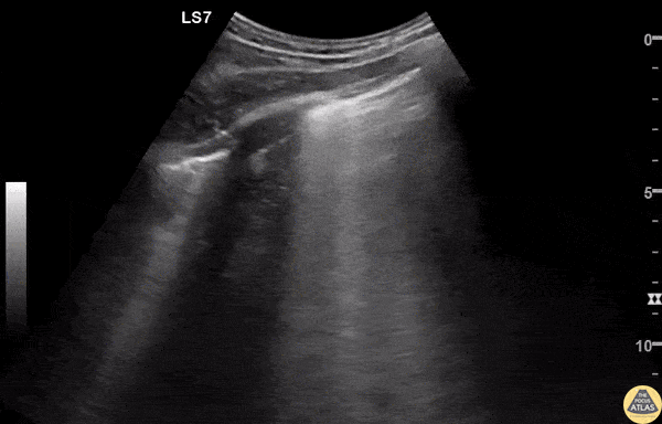 Pulmonary - B lines - Aspiration Pneumonitis