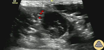 Nerve Block Gallery - Interscalene Nerve Block