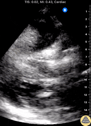 Trauma - Free Peritoneal Fluid with Falciform Ligament