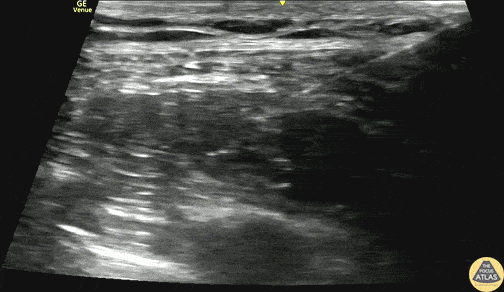 Nerve Block Gallery - Serratus Anterior Plane Block for Chest Tube Placement