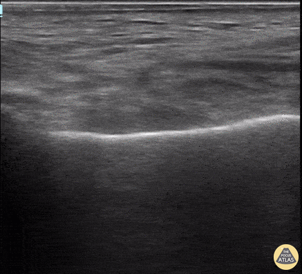 Soft Tissue - Parotid Gland Malignancy