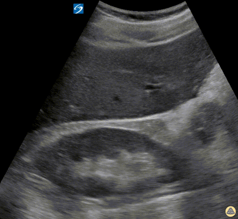 Trauma - Positive FAST